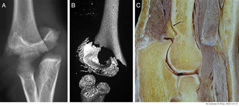 Fractura Supracondílea Del Codo Y El Mito De La Rotación Del Fragmento