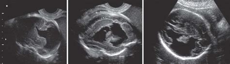 Porencephaly At 25 Weeks Of Gestation Upper Left Transvaginal Us Download Scientific Diagram