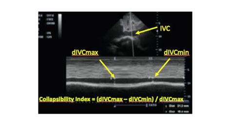 Ultrasound Measurements Of Inferior Vena Cava Ivc And Calculation Of