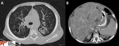 Pathology Pearls Hepatobiliary Manifestations Of Cystic Fibrosis Aasld