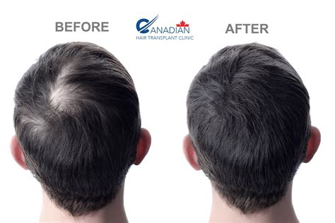 Canadian Hair Transplant Clinic Hair Transplant In Mississauga Fue Transplant