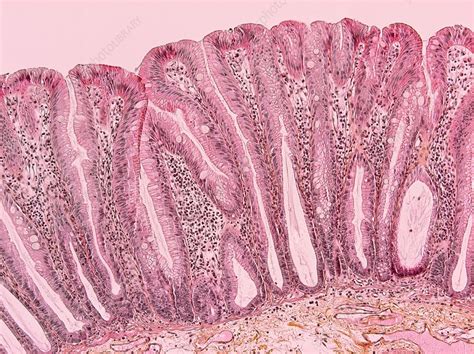 Colon Cancer Light Micrograph Stock Image C021 3116 Science