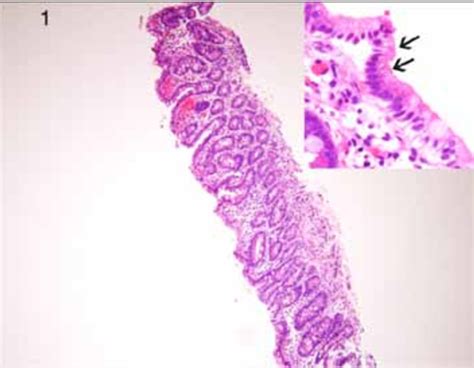 Duodenal Biopsy Showing Thin Mucosa Due To Villous Atrophy Hande ×