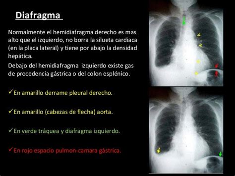 Torax Normal