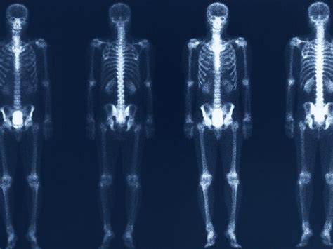 Osteomyelitis Bone Scan