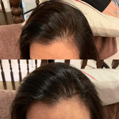 Explained The Reasons Behind Female Pattern Hair Loss Hair Care Specialist Hair Replacement