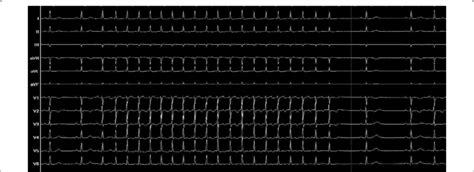 A 12 Lead Electrocardiogram Demonstrating A Narrow QRS Complex