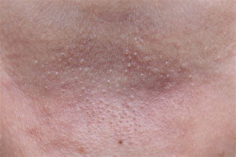 What Is Prickly Heat Rash