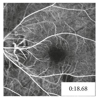 Multimodal Imaging Characteristics Of A Year Old Girl With Acute