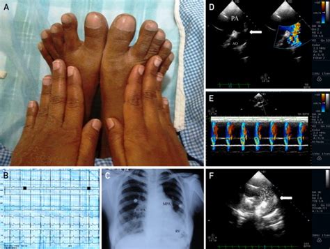 Differential Clubbing And Cyanosis Classic Signs Of Patent Ductus Arteriosus With Eisenmenger