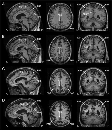 T1 Weighted Sagittal Axial And Coronal Images As Exam Open I