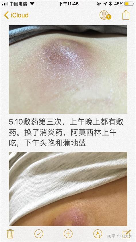 原来我长的不是疖子而是皮脂腺囊肿又称粉瘤 知乎