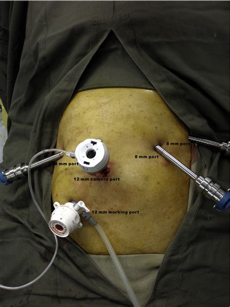 Figure 1 From Robot Assisted Laparoscopic Hemi Hepatectomy Technique