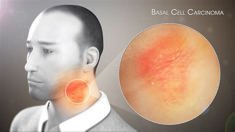 Basal Cell Carcinoma Shown & Explained Using A 3D Medical Animation