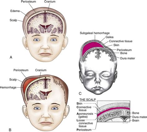 Caput Succedaneum Vs Cephalohematoma