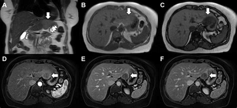 Fat Containing Lesions Of The Liver A Review Of Differential Diagnoses