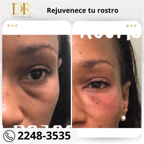 Rejuvenece tu rostro con la mejor técnica del país Dr Eric Rojas