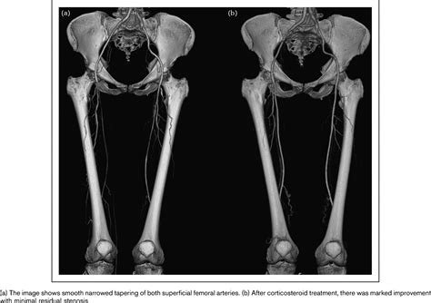 Lower Extremity Vasculitis In Polymyalgia Rheumatica And Gia