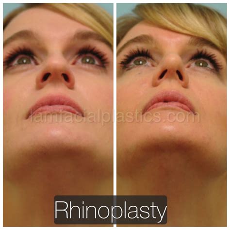 Rhinoplasty Dallas Nose Job Plano Nose Surgery Doctor