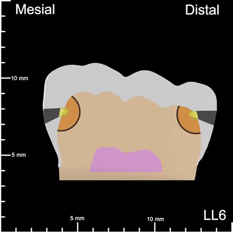 Ll Mesial And Distal Decay K Teeth