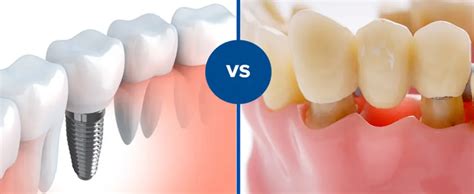 Implantes O Puentes Dentales Qu Es Mejor Cleardent Cl Nicas