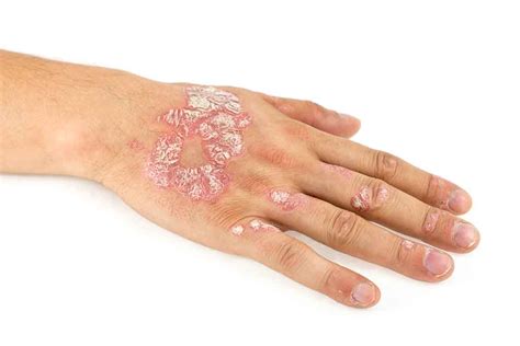 Psoriazis Afla Ce Functioneaza Cu Adevarat
