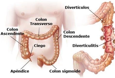 Qué Es Y Cómo Se Trata La Estenosis Diverticular Del Colon Que Sufre El