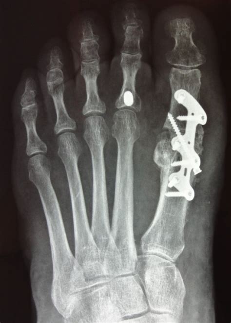 Hallux Valgus Dr Michael Vitek Wien