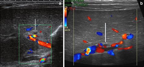 Biliary Atresia With Microcyst A Oblique Color Doppler Us Shows A