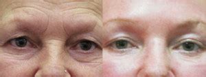 Laser Resurfacing Dr Denise Hyland