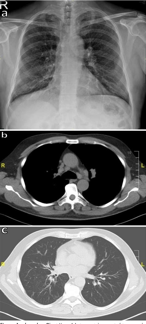 Figure From Sarcoid Like Reaction Mimicking Nodal Spread Of Lung