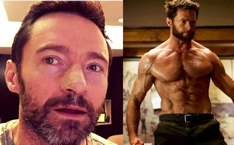 Hugh Jackman Cáncer De Piel La Enfermedad Que Afecta Al Actor Grupo