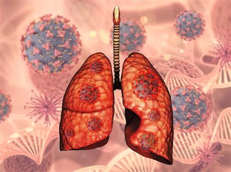 Pengertian Pneumonia Memahami Infeksi Yang Menyerang Organ Paru Paru Manusia