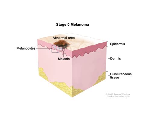 Figure Stage Melanoma In Situ Abnormal Melanocytes Are In The