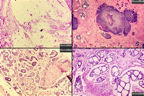 Adenoid cystic carcinoma