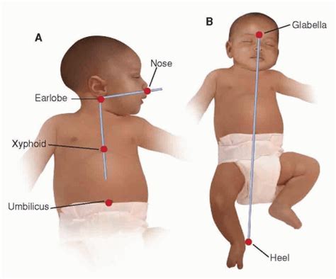 Orogastric Tube Neonate