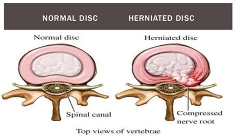 Intervertebral Disc Prolapse Ivdp