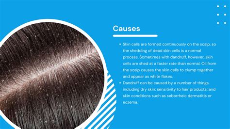 Ppt Facts And Causes Of Dandruff Hair Ensure Powerpoint Presentation Id 11797442