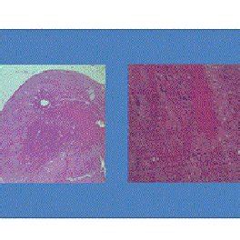 Histology Of The Right Adrenal Gland Macronodular Hyperplasia Showing