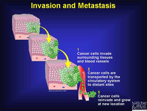 CISN - Metastatic Information