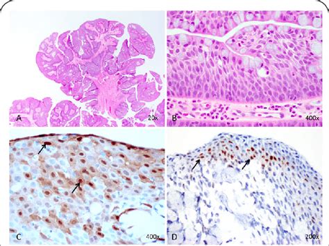 Pathology Images After Surgical Excision Of Lesion Ab Hematoxylin