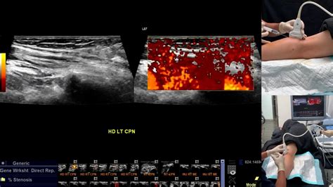 Ultrasound Guided Nerve Hydrodissection For Pain Management Supplementary Video 7 [id 247208