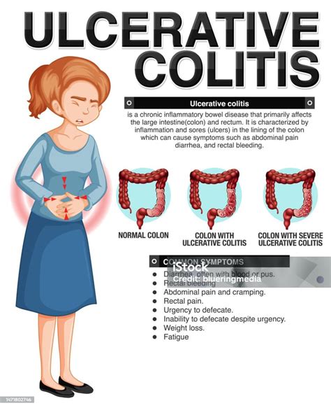 Ilustración De Infografía De Síntomas De Colitis Ulcerosa Y Más Vectores Libres De Derechos De