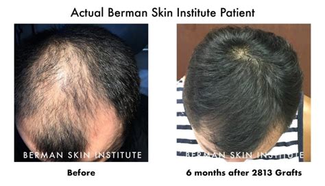 Hair Transplant Before And After Resultsdr Bermanartas Robotic Hair