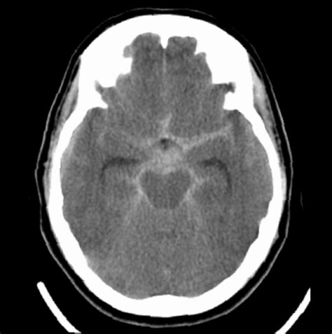 Neurosciences ABPN Neurology Boards Glossary Intracranial