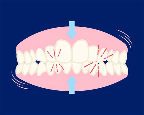 Teeth Grinding Causes Effects And Solutions