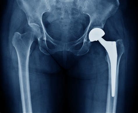 Total Hip Replacement Complications Types Of Hip Replacement