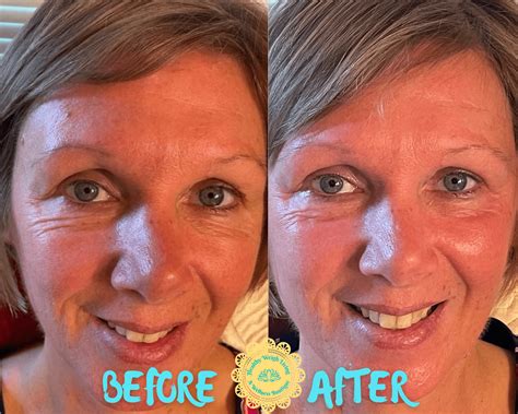 Infrared Thermal Facelift Anti Aging Treatment The Villages Fl