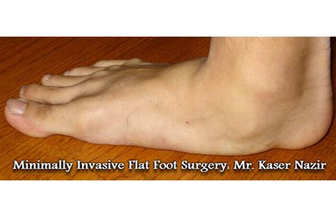 Minimally Invasive Flat Foot Surgery: Mr. Kaser Nazir - Londonfootandanklesurgery.co.uk