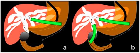 Procedure Process Of Endoscopic Ultrasound Guided Hepaticogastrostomy